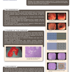 Poster: Rapid Lymphoma Development poster-rapid-lymphoma-development